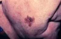 skin cancer 5
