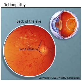 retinopathyLarge