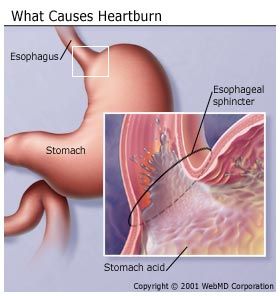 What Causes Heartburn