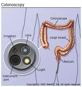 Digestive Problems - Colonoscopy
