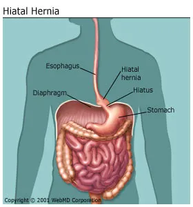 Hernia meaning