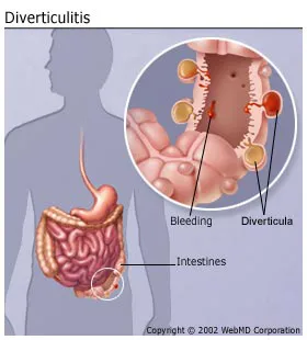 Diverticulitis - Diagnosis and treatment - Mayo Clinic