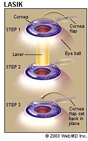 Recenzii cu laser cu rezoluții oftalmice la spital