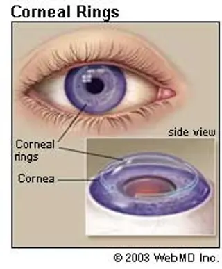Eye Health - Corneal Rings