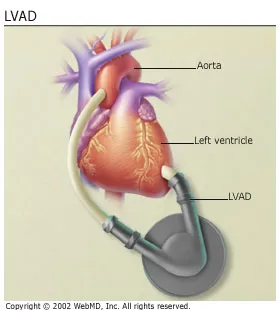Left Ventricular Assist Device (LVAD) for Heart Failure