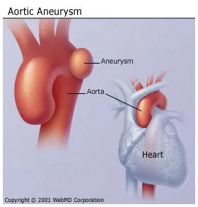 aortic aneurysm