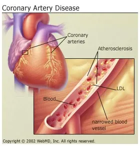 basics on heart disease
