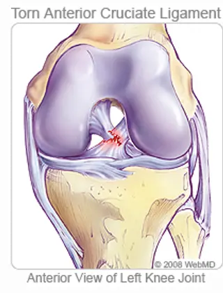 Illustration of torn ACL in left knee joint