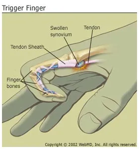 trigger finger( thumb) a könyök ízületének vállízülete