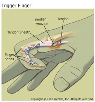 trigger-finger