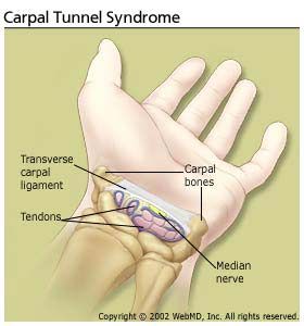 carpal tunnel syndrome)
