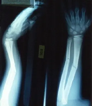 broken arm 1