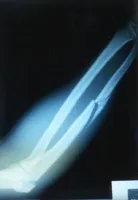 broken arm 2