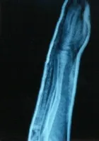 broken arm 4