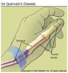 De Quervain szindróma, De Quervain tendonitis kezelése - Súlypont Ízületklinika