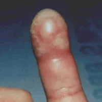 Finger Infection Photo