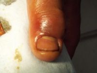 Finger Infection Photo