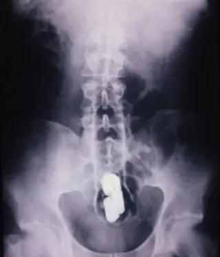 Foreign Body in Rectum Image