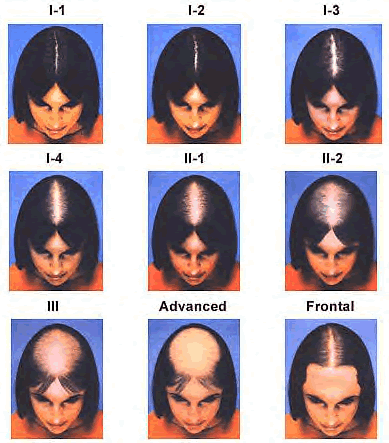 The Savin Scale shows patterns of hair loss.
