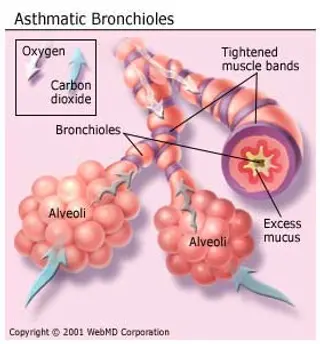 Asthmatic Bronchioles