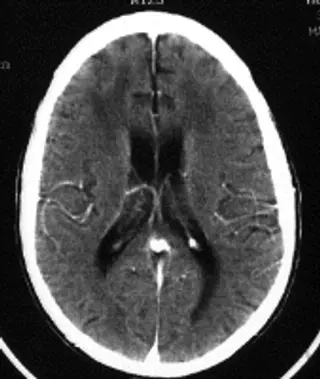 Dementia Due to HIV Infection CT