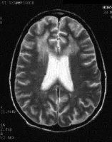 Dementia Due to HIV Infection MRI