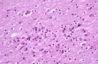 Dementia Due to HIV Infection Photomicrograph