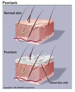 psoriasis illustration