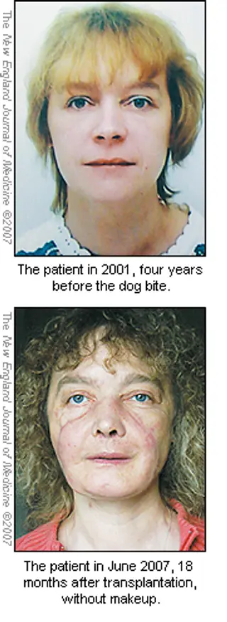 human partial face transplantation