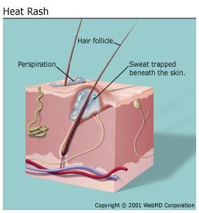 heat rash