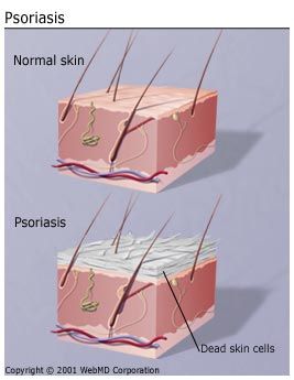 get the basics on psoriasis 