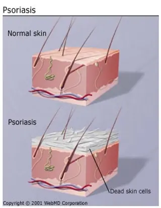 get the basics on psoriasis 