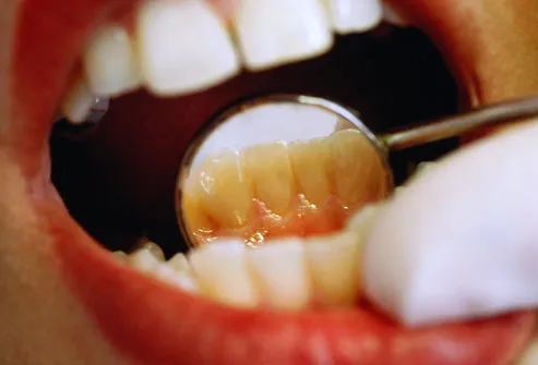 Dental patient's mouth being inspected with mirror