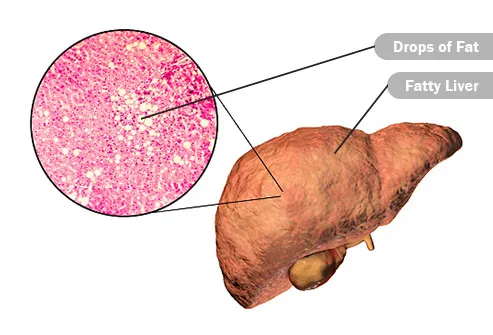 fatty liver illustration