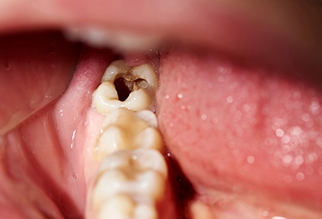 Harm: Cavities