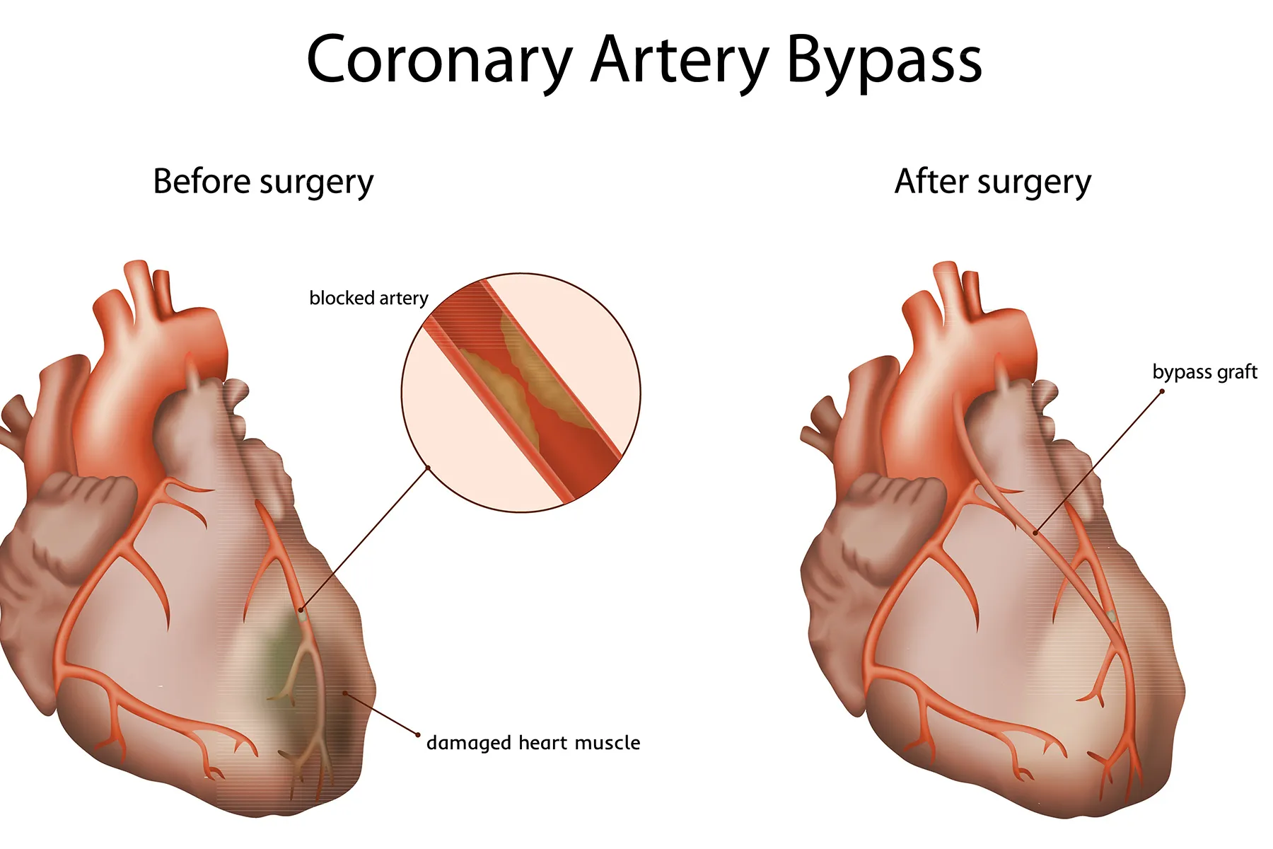 photo of Coronary Artery Bypass