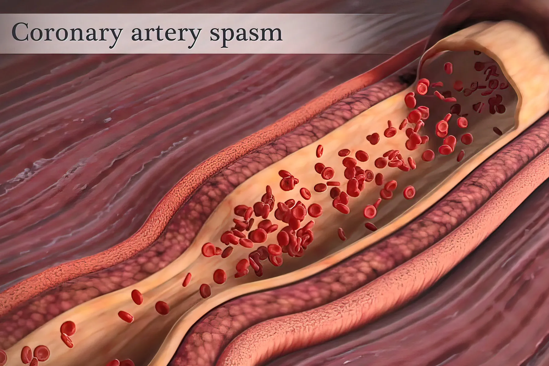 photo of Coronary Artery Spasm