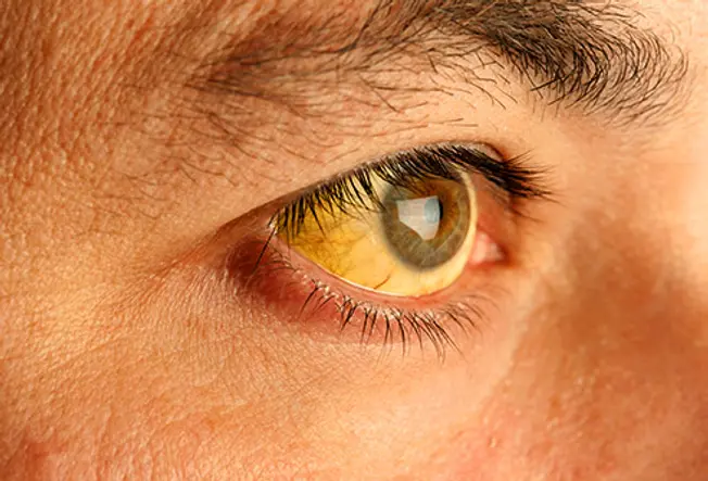 Yellowish Skin and Eyes