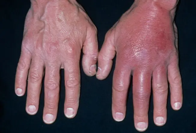 MRSA Skin Infection: Cellulitis