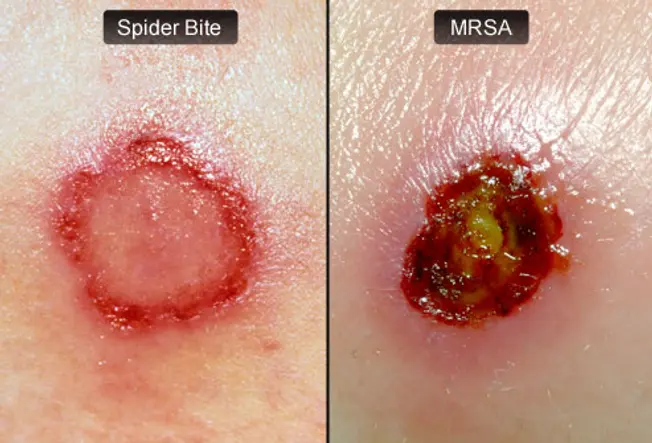 MRSA, Spider Bite or Something Else?