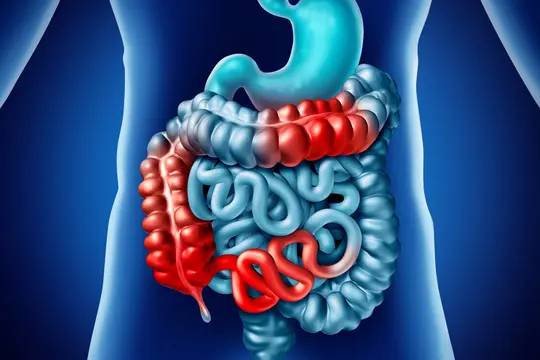 photo of Crohn's Disease