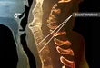 anklyosing spondylitis fused vertebrae
