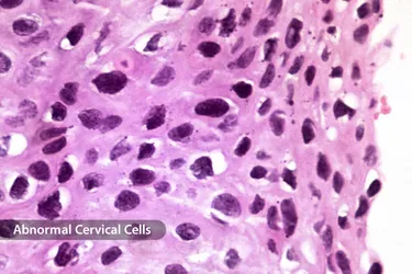hpv causes abnormal cells virus papiloma en la mujer