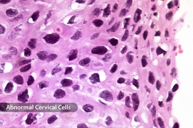 photo of abnormal cervical cells