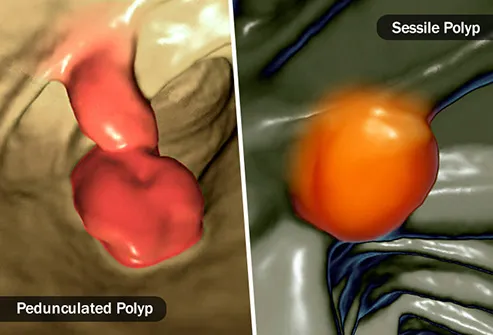 endometrial cancer in polyp