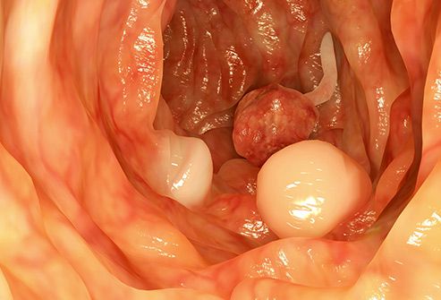 endometrial cancer in polyp)