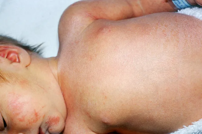 baby with roseola rash