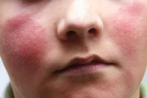 fifth disease childs cheeks