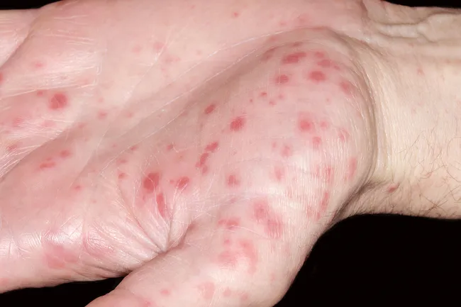 Pictures Of Viral Rashes In Adults Children