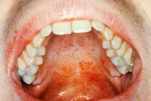 throat rash mononucleosis